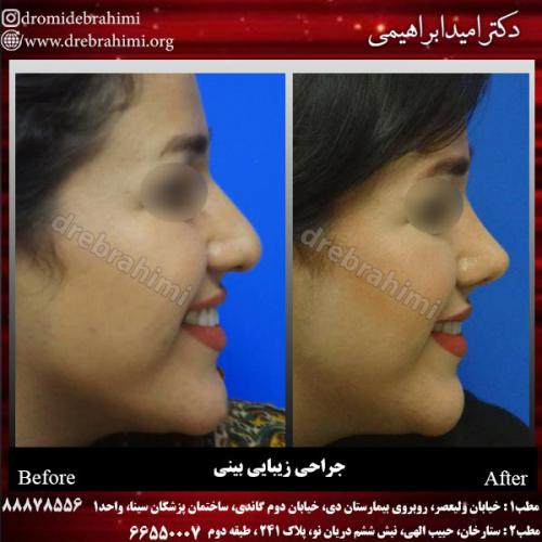 عمل-زیبایی-بینی-87