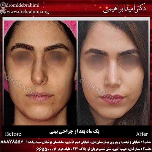 عمل-زیبایی-بینی-88