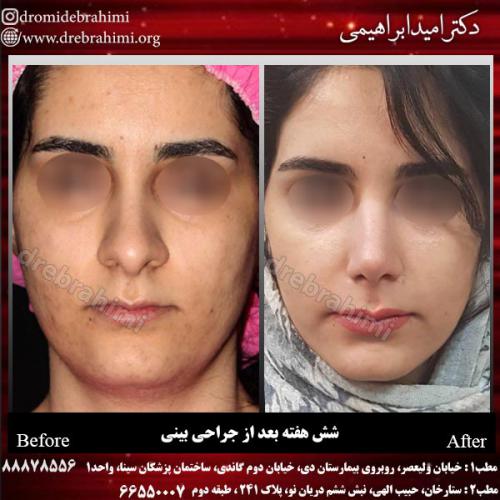 عمل-زیبایی-بینی-90