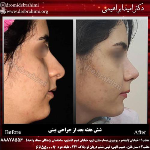 عمل-زیبایی-بینی-91