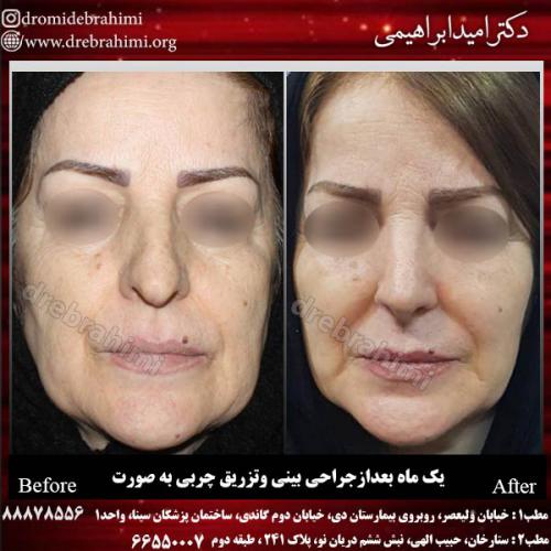 عمل-زیبایی-بینی-92