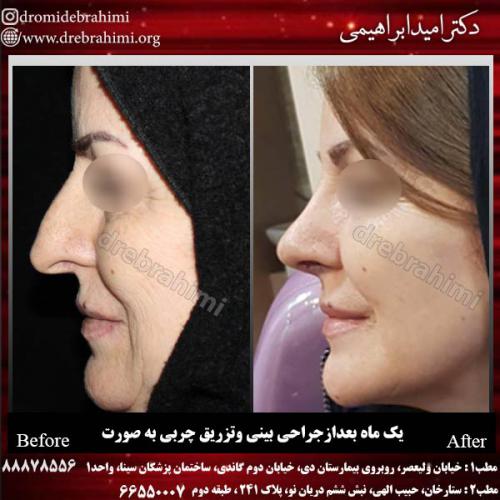 عمل-زیبایی-بینی-93